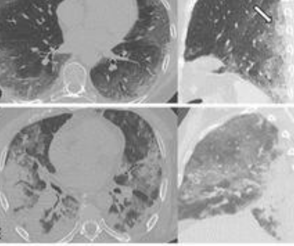 Study Finds Over Half of Patients with COVID-19 Pneumonia Have Pulmonary Abnormalities One Year Later