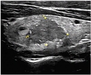 Ultrasound-Based Nomogram May Enhance Risk Stratification for Thyroid Nodules with Peripheral Calcifications