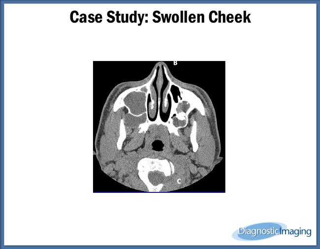Swollen Cheek