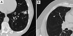 AI May Bolster Assessment of Pulmonary Nodules on Chest CT