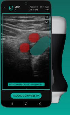 FDA Clears Ultrasound Guidance Software on Vascular Imaging for DVT Evaluation