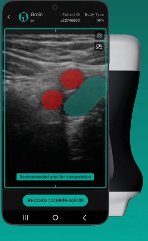 FDA Clears Ultrasound Guidance Software on Vascular Imaging for DVT Evaluation