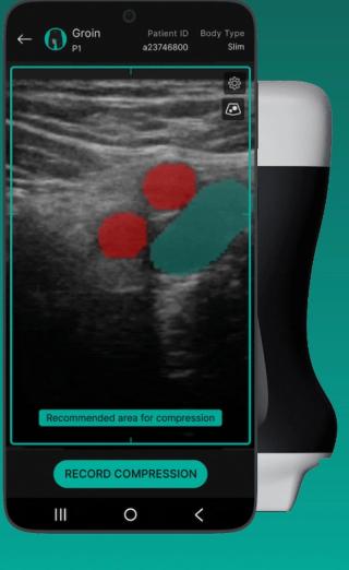 FDA Clears Ultrasound Guidance Software on Vascular Imaging for DVT Evaluation