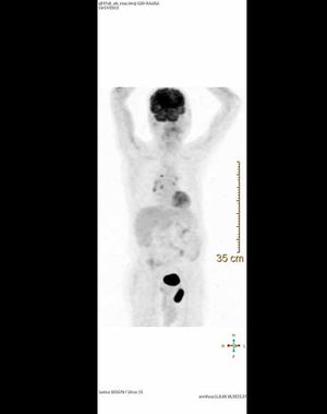 Bladder Hernia Simulating Left Inguinal Metastasis on PET/CT 