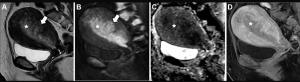 What New MRI Research Reveals About Endometrial Cancer Staging and the 2023 FIGO Staging System