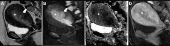 What New MRI Research Reveals About Endometrial Cancer Staging and the 2023 FIGO Staging System