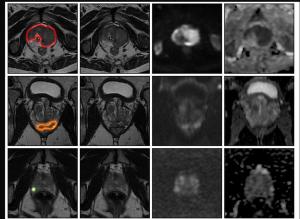 What a Large Prostate MRI Study Reveals About AI and Unassisted Radiologist Assessment