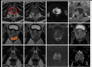 What a Large Prostate MRI Study Reveals About AI and Unassisted Radiologist Assessment