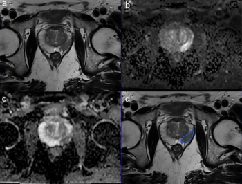 Emerging Concepts and Recommendations for MRI in Prostate Cancer Screening