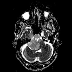 Image IQ: 41-year-old Female with Chronic Headache