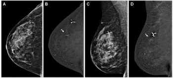 Study: Contrast-Enhanced Mammography Offers Significantly Higher Sensitivity for Breast Cancer in Dense Breasts