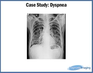 Dyspnea