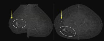 Current Insights and Emerging Roles for Contrast-Enhanced Mammography