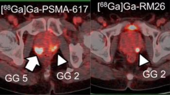 Can PSMA PET Reinvent Risk Stratification for Prostate Cancer?