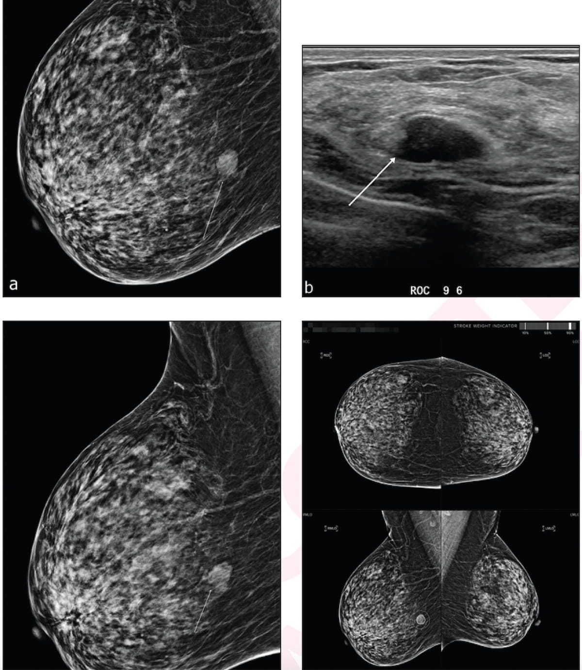 Researchers Note Lack Of Benefit with AI in Women with Dense Breasts