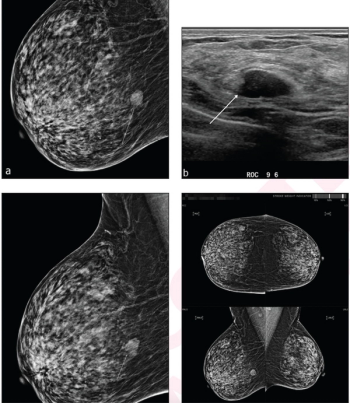 Researchers Note Lack Of Benefit with AI in Women with Dense Breasts