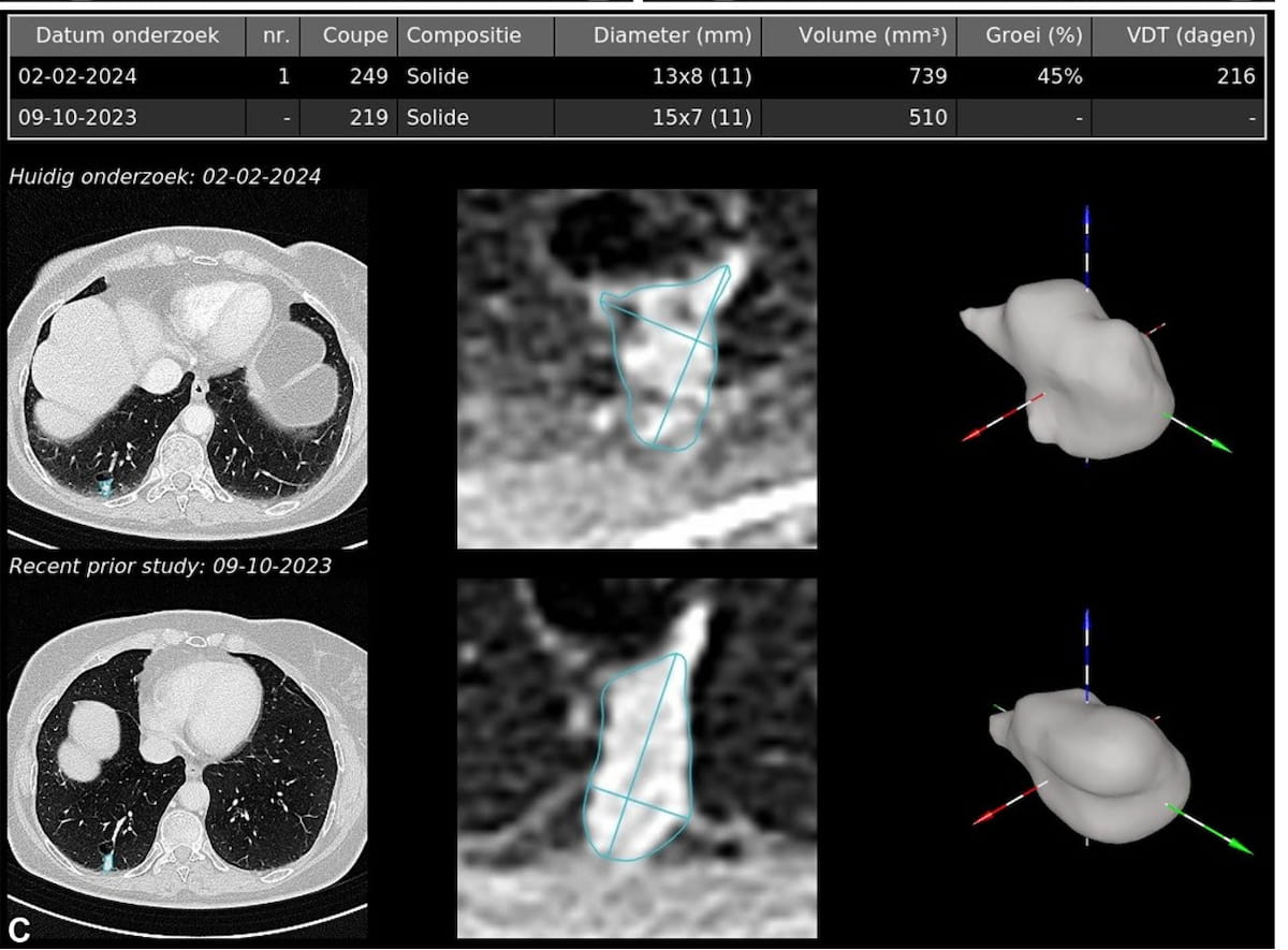 Study: Chest CT AI Software Facilitates Nearly 15 Percent Reduction in Reporting Time