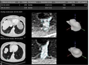 Study: Chest CT AI Software Facilitates Nearly 15 Percent Reduction in Reporting Time