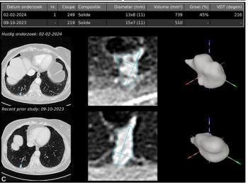 Study: Chest CT AI Software Facilitates Nearly 15 Percent Reduction in Reporting Time