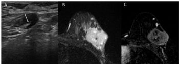 Breast MRI and Ultrasound Findings Linked to Elevated Risk of Axillary Residual Disease After Neoadjuvant Therapy