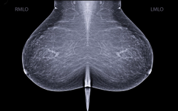 Breast Cancer Screening: Five Takeaways from New Systematic Review of Global Guidelines
