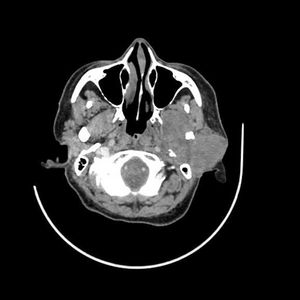Neoplastic Left Parotid Mass Proven as Squamous Cell Carcinoma