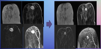 Can Abbreviated Breast MRI Have an Impact in Assessing Post-Neoadjuvant Chemotherapy Response?