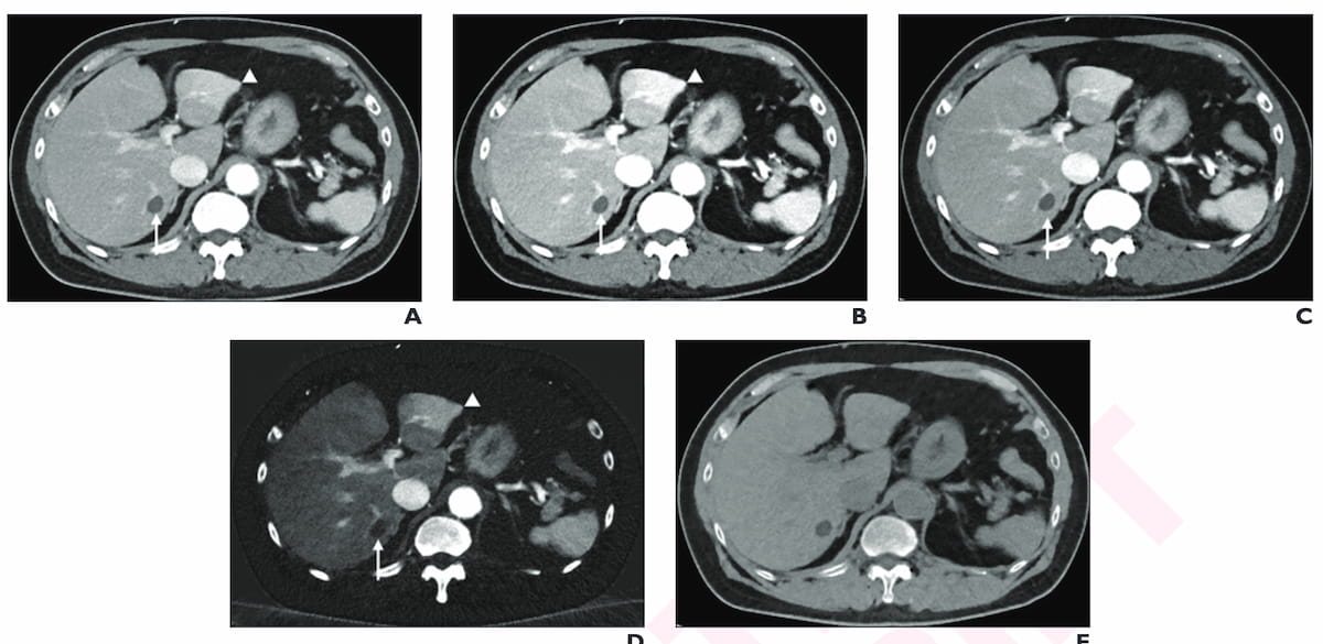 Nine Takeaways from New Consensus on Abdominal Photon-Counting CT Protocols in Adults