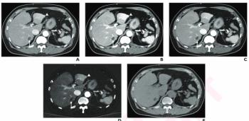 Nine Takeaways from New Consensus on Abdominal Photon-Counting CT Protocols in Adults