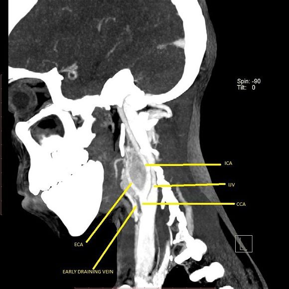 Phelp Sign Radiology Carotid Body Paraganglioma