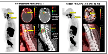 Can Targeted PSMA PET/CT-Guided Radiotherapy Have an Impact for Oligometastatic Prostate Cancer?