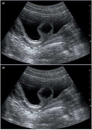Orthotopic Ureterocele