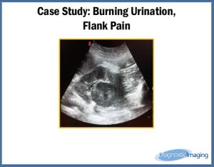Burning Urination, Flank Pain