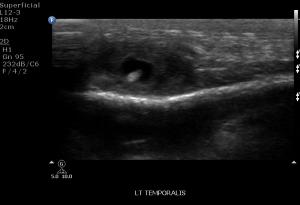 Image IQ: 13 y/o, Painful Swelling in Temporal Region