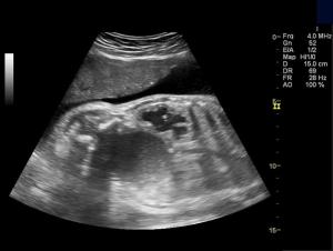Image IQ: 32-week Female Fetus with Anomaly