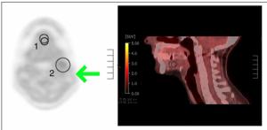 PET Radiotracer Gets FDA Breakthrough Therapy Designation for Tumor Hypoxia Detection in HPV-Positive Oropharyngeal Carcinoma
