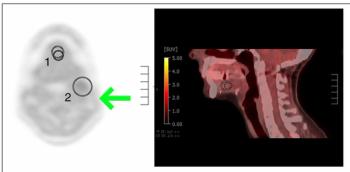 PET Radiotracer Gets FDA Breakthrough Therapy Designation for Tumor Hypoxia Detection in HPV-Positive Oropharyngeal Carcinoma