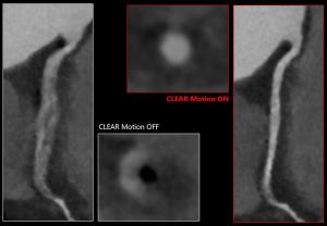 Canon Medical Unveils Advances in AI-Enabled CT Software