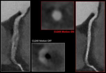 Canon Medical Unveils Advances in AI-Enabled CT Software