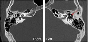 Post-traumatic Ossicular Dislocation