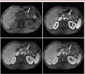 Can a New MRI-Based Risk Stratification Model Bolster Survival Prediction with Pancreatic Ductal Adenocarcinoma?