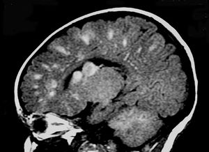 Image IQ Quiz: Young Patient Presents with Chronic Seizures