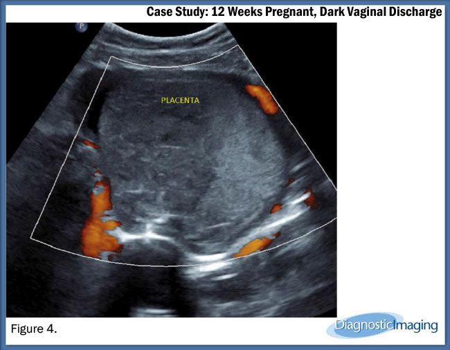 12 Weeks Pregnant, Dark Vaginal Discharge