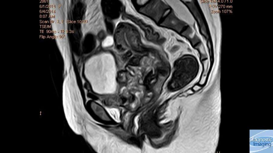 Postmenopausal Bleeding Pelvic Pain postmenopausal-bleeding-pelvic-pain