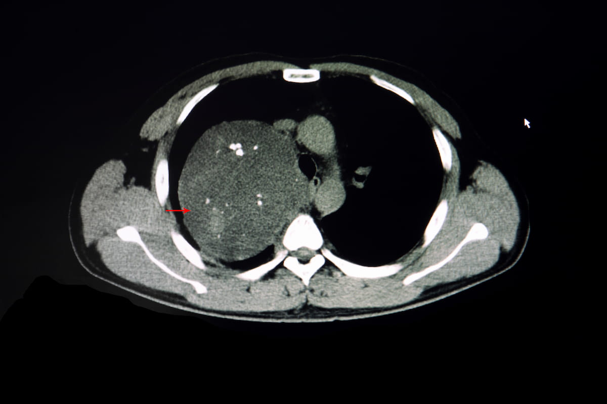 Eleven Takeaways from New Analysis of CT-Based AI for Lung Cancer Screening