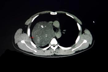 Eleven Takeaways from New Analysis of CT-Based AI for Lung Cancer Screening