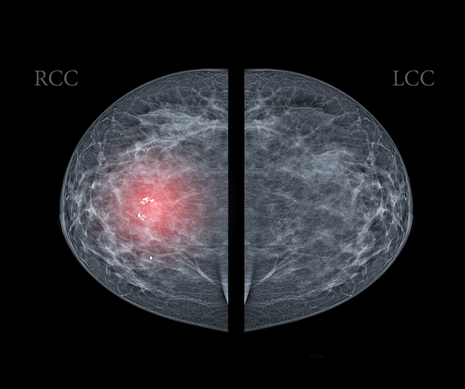 Screening Mammography and Breast Arterial Calcification: What a New Study Reveals