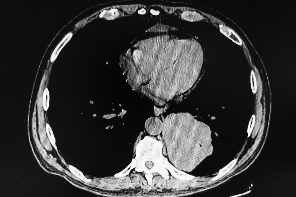 Is It Time to Revisit Low-Dose CT Screening Protocols in Patients at High Risk for Lung Cancer?