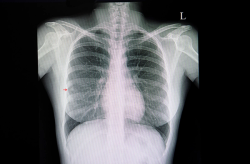 Can Deep Learning Enhance Pulmonary Nodule Detection on Chest X-Rays?