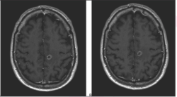 Algorithm Can Classify Major Intracranial Tumor Types from a Single MRI Scan 
